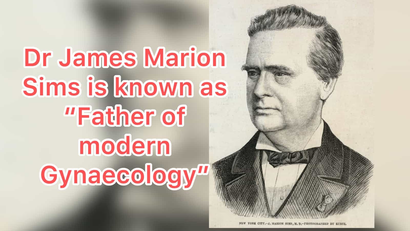 Dr James Marion, Father of Modern Gynaecology